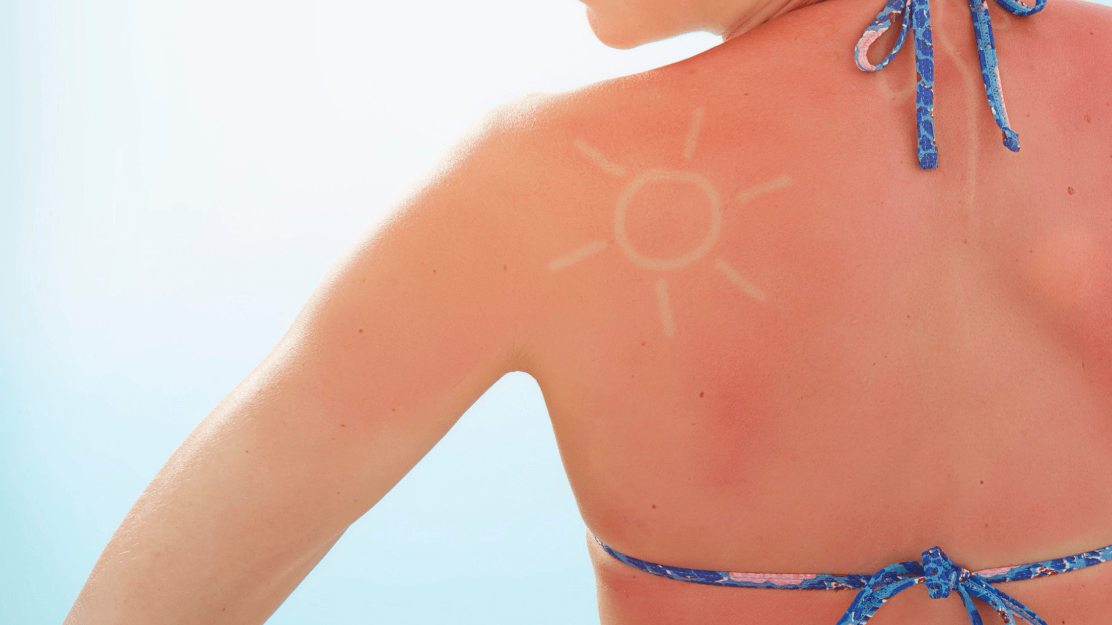Zonschade aan de huid grootste oorzaak huidkanker en huidveroudering